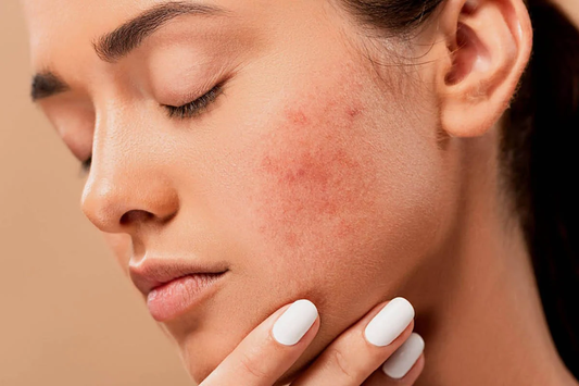 Managing skin sensitivity: Causes and treatment for sensitive skin -